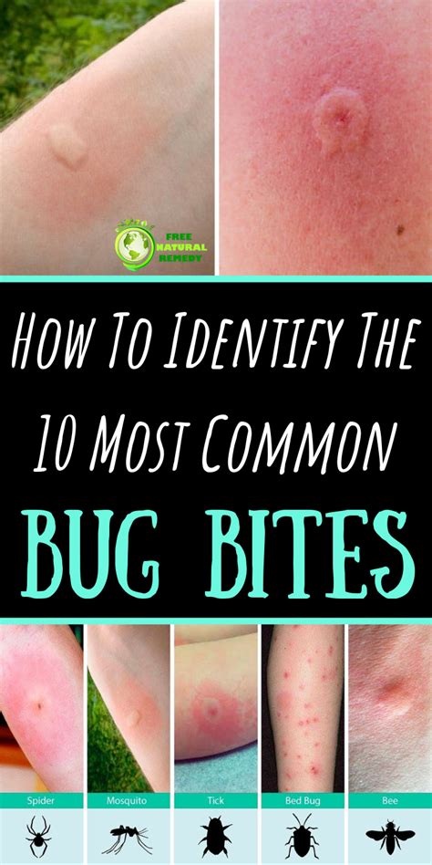 10 Bug Bites Anyone Should Be Able to Identify in 2020 | Bug bites remedies, Bug bites, Remedies ...