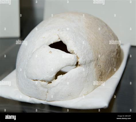 Phineas Gage skull, on display at Harvard Medical School. Hole in the ...