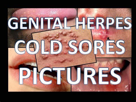 Genital Herpes Cold Sores Pictures - YouTube