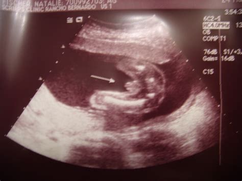 Natalie's Pregnancy Blog: 19 weeks 6 days- Ultrasound techs are sadists.