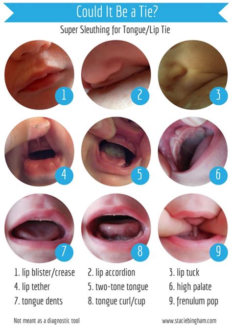 Tongue and Lip Tie Therapy – South African Airway and Myofunctional Society