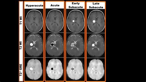 MRI findings of different stages of haemorrhage - YouTube