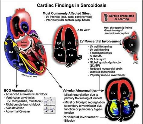 What Causes Ventricular Hypokinesis Tlobag | Images and Photos finder