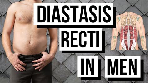 Diastasis Recti In Men Causes Symptoms Treatment Evolving World | The Best Porn Website