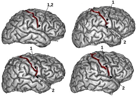 Where should the central sulcus end? The folds that may belong to the... | Download Scientific ...