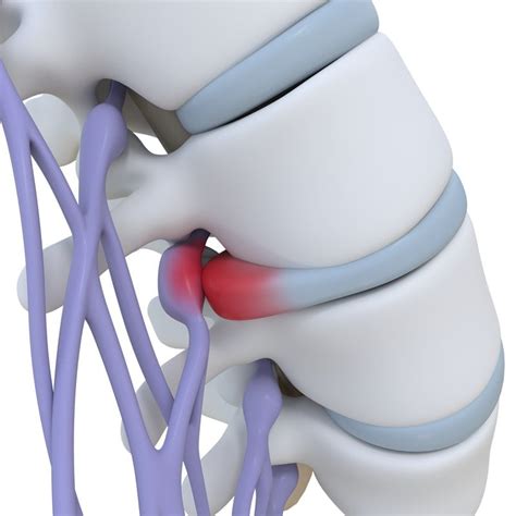 Bulging Disc | BioSpine Institute