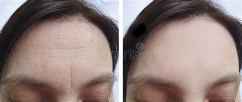 Female Forehead Wrinkles before Treatment Biorevitalization Stock Image ...