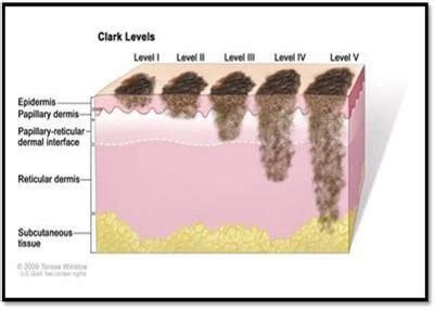 Melanoma Skin Cancer Stages