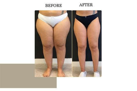 Lipedema | Before & After