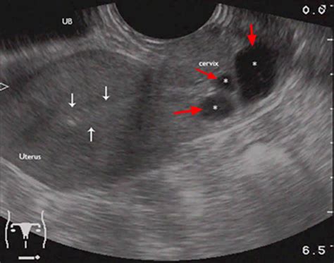 Nabothian cyst in cervix causes, symptoms & nabothian cyst treatment