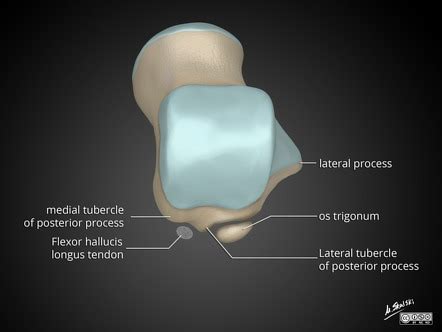 Posterior talar process fracture | Radiology Reference Article | Radiopaedia.org