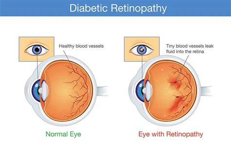 Diabetic Retinopathy; Symptoms, Causes, Complications & Treatment - Page 4