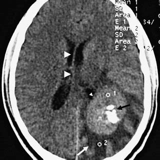 (PDF) Primary Skull Osteosarcoma: MDCT Evaluation and Histopathological Correlation in Two Cases