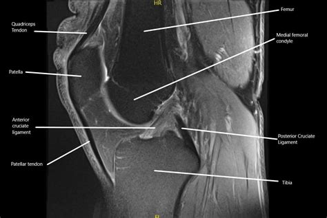 Anterior Cruciate Ligament Mri