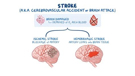 Subarachnoid Hemorrhage Stroke