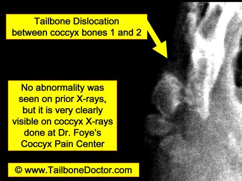 Tailbone Images (for coccyx pain) | Tailbone Doctor