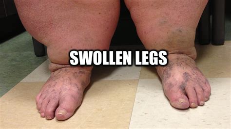 Do you have swollen legs? Read about causes, diagnosis and treatment