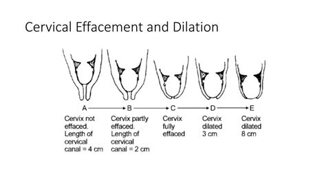 Cervical Dilation Finger Chart