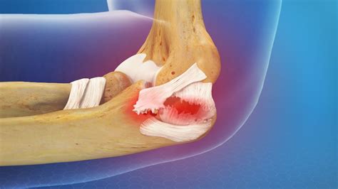 Elbow Ligament Injury: Causes, Symptoms And Tips To Help