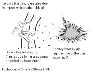 Blast Injury Types, Signs, Symptoms, Diagnosis Treatment, 54% OFF