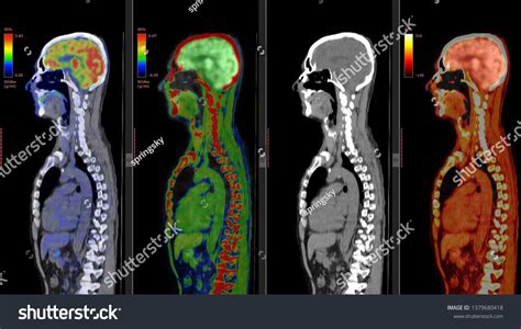 Pet Ct Scan Human Brain Positron Stock Photo (Edit Now) 1379680418