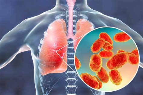 Bacterial Pneumonia Associated With Increased Risk for Future MACE - The Cardiology Advisor