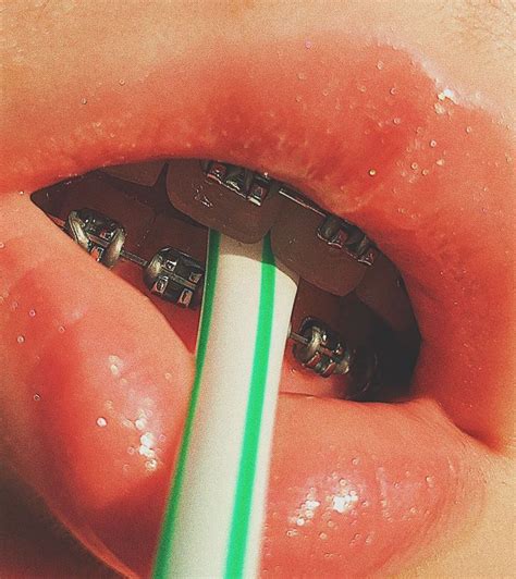 aesthetic @abiingell #lipsaesthetic in 2020 | Cute braces colors, Lips drawing, Cute braces