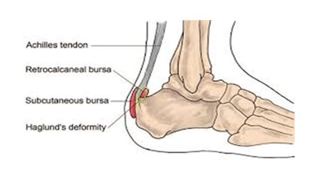 Posterior heel pain — Chelsea and Westminster Hospital NHS Foundation Trust