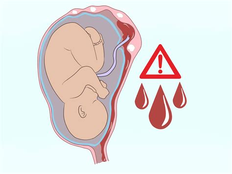 Simple Ways to Deal with Fibroids During Pregnancy: 9 Steps