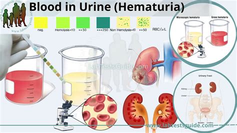 Hematuria Explained | Lab Tests Guide