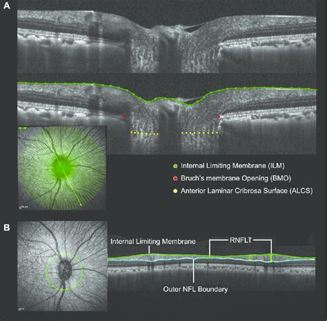 Original and delineated spectral-domain optical coherence tomography... | Download Scientific ...