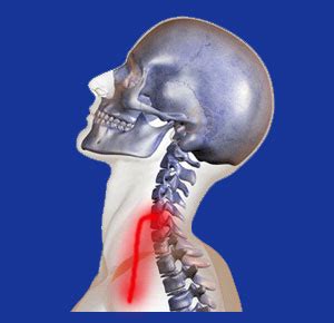 Cervical Nerve Compression - Neck Pain