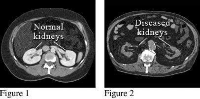 CT KUB Scan: Price, Purpose, Procedure, & Contrast [2024]