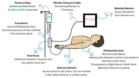 Arterial Line Basics for Critical Care Nurses - ISeeU_Nurse with Sarah ...