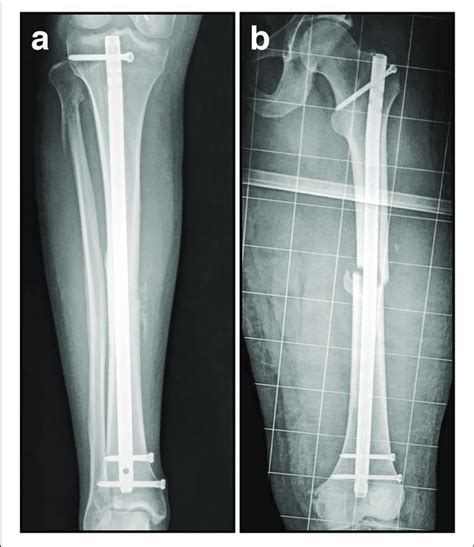 Im Nailing Tibia Procedure - Nail Ftempo