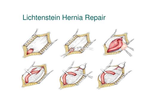 PPT - Abdominal Wall Hernias PowerPoint Presentation, free download - ID:5466148