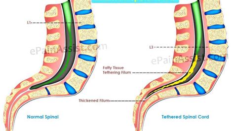 Tethered spinal cord syndrome