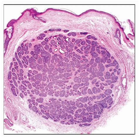 Cylindroma | Basicmedical Key