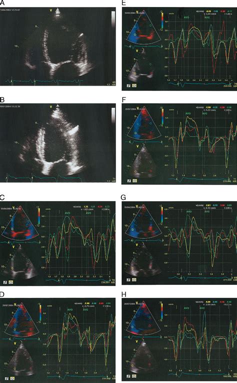 Benefits of Cardiac Resynchronization Therapy for Heart Failure Patients With Narrow QRS ...