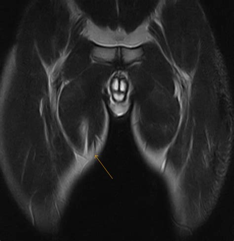 Adductor Strain-MRI - Sumer's Radiology Blog