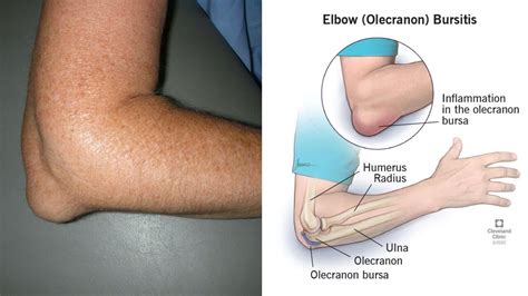 Bodybuilder's Elbow: Bursitis, Elbow Growth, Pointy Elbow