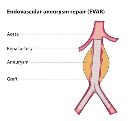 IR Procedures – SNRIR