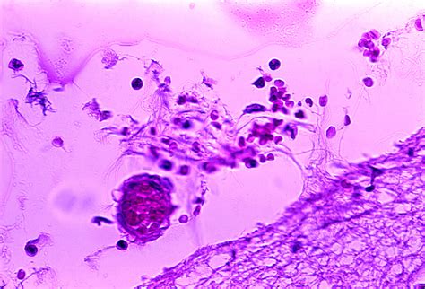 Free picture: mild, meningitis, hemorrhage, bacillus anthracis