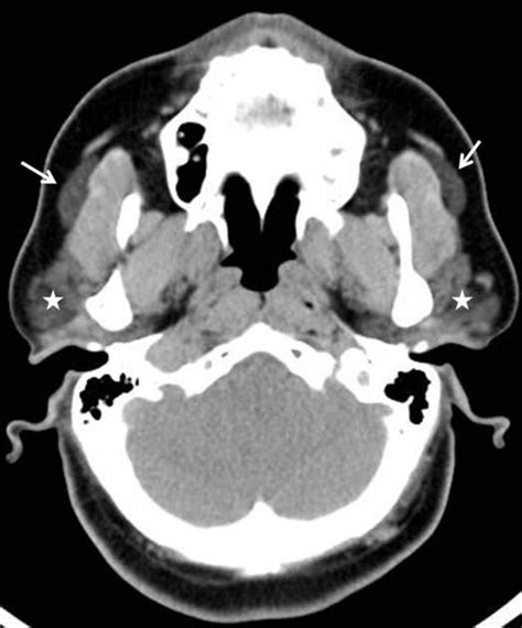 Bilateral accessory parotid glands (arrows) with normal parotid glands ...