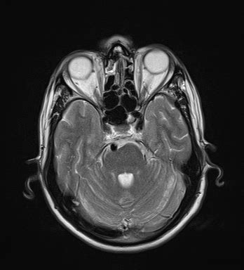 Ultimate Radiology : Dolichoectasia of the Vertebrobasilar System