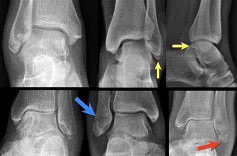 The Radiology Assistant : Ankle fractures - Weber and Lauge-Hansen ...