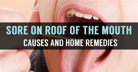 What is Roof of the Mouth Sore? Know its Causes & Remedies