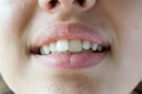 15 Common Causes of Angular Cheilitis You Shouldn't Ignore - OptingHealth