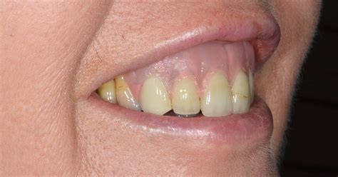 Gingival Veneers Case Study- Lichfield Dentist