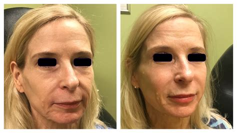 2018-06 Liquid Face lift - 1 • Babcock Dermatology